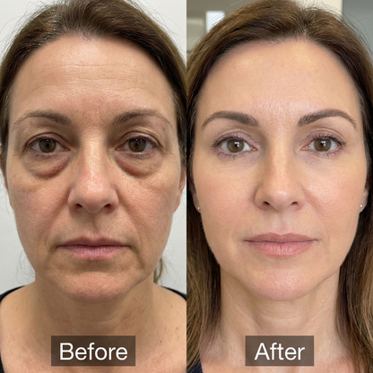 LumiLift Eye Sculptor